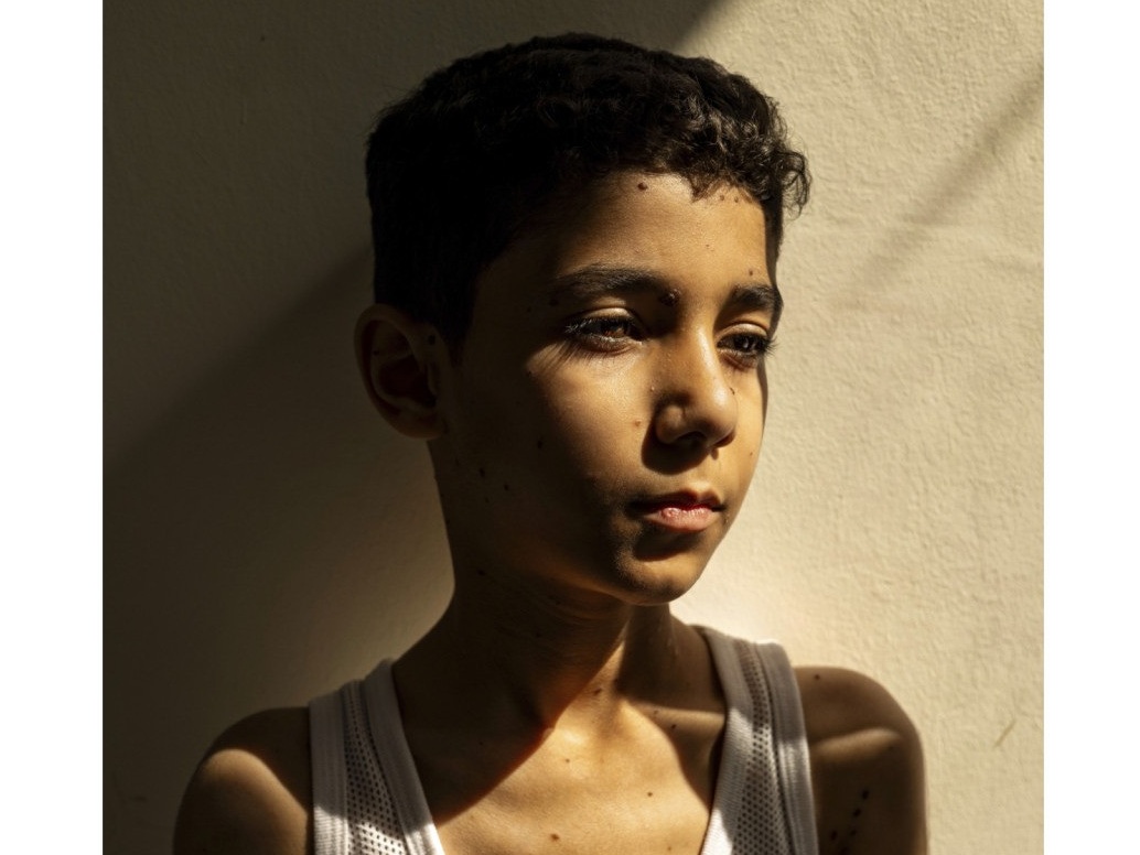 Mahmoud, il bambino amputato a Gaza, è la foto dell’anno
